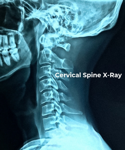 Cervical Spine X-Ray