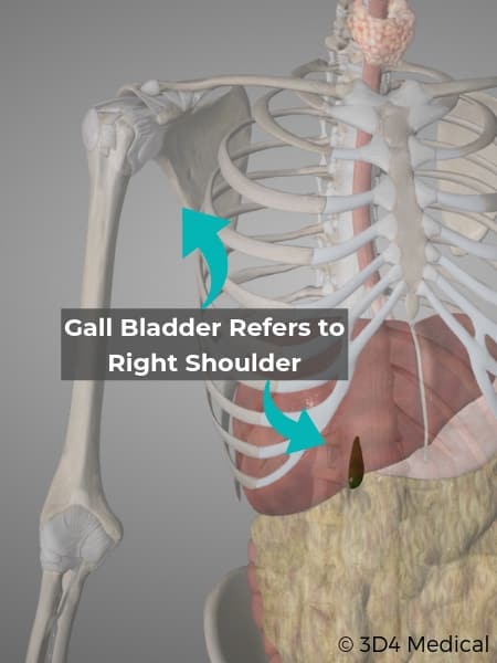 Gall Bladder Pain Referral