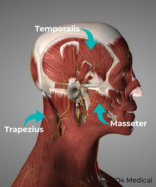 Muscular Causes of Headaches