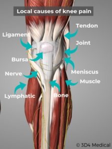 Knee Pain Symptoms and Treatment - Geelong Osteopaths